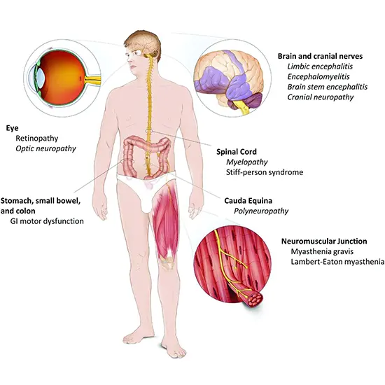 paraneoplastic neurologic syndrome package test